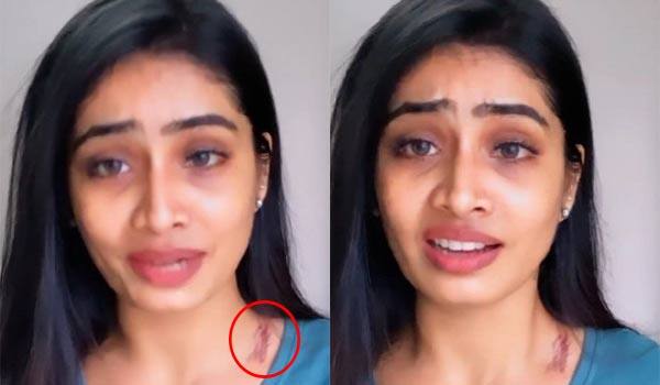 Serial-actress-Sivanya-accident:-A-tearful-interview-with-a-scar-on-her-neck