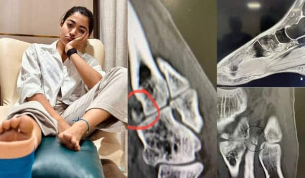 Rashmika-shares-X-ray-photos-of-leg-fracture