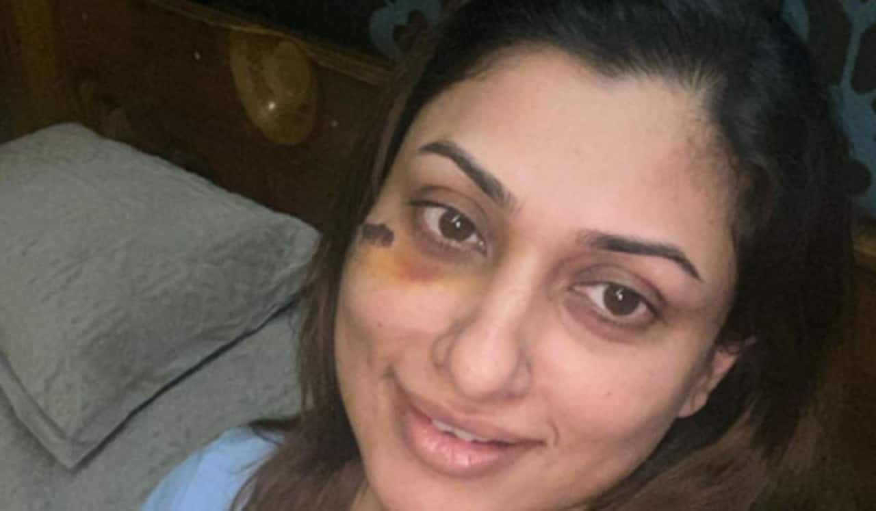 சைக்கிளிங் சென்ற போது விபத்து: அஜித் பட நாயகிக்கு கை விரல் முறிவு
