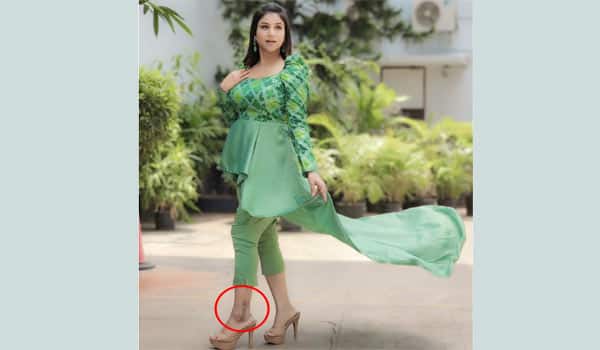 ஆல்யாவின் காலில் எவ்வளவு பெரிய தழும்பு?