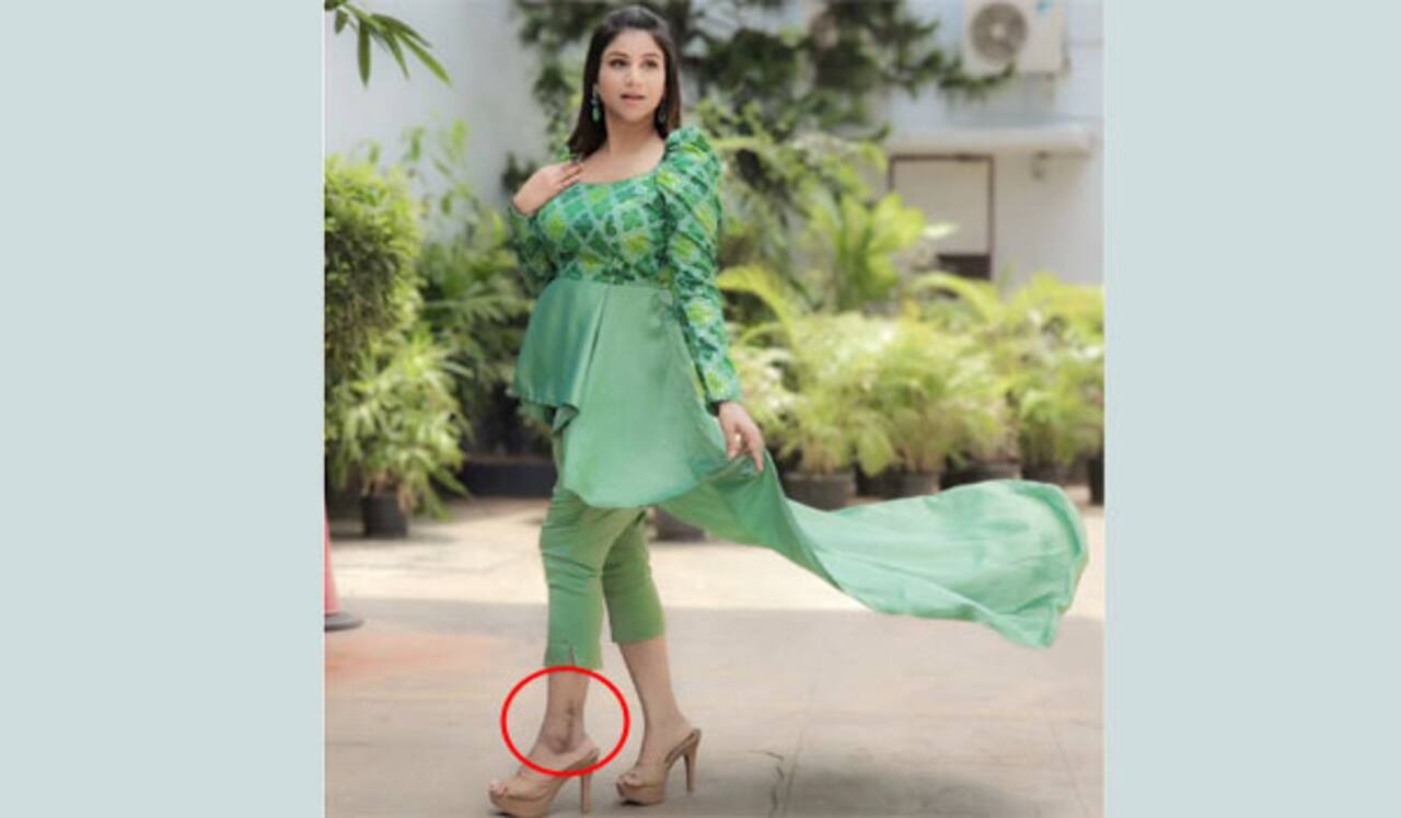 ஆல்யாவின் காலில் எவ்வளவு பெரிய தழும்பு?