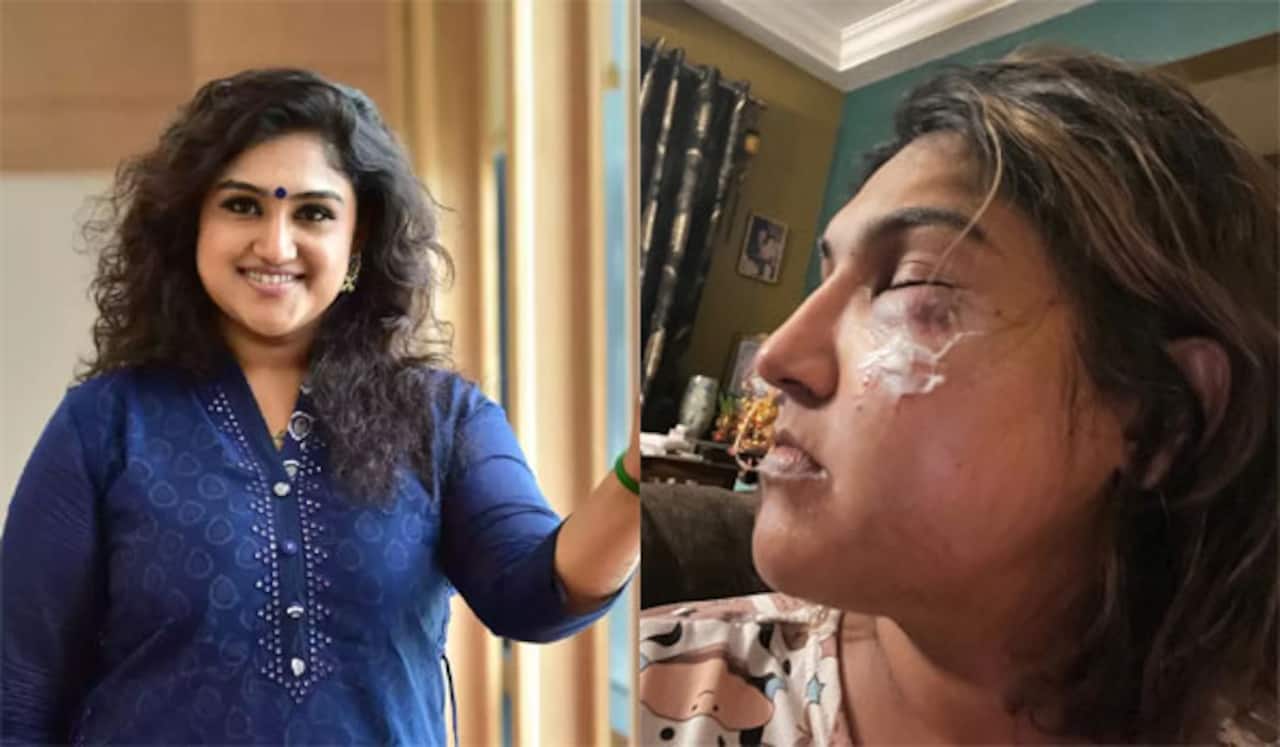 வனிதா மீது மர்ம நபர் தாக்குதல்: காயத்துடன் இருக்கும் படத்தால் பரபரப்பு