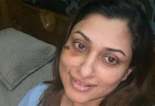 சைக்கிளிங் சென்ற போது விபத்து: அஜித் பட நாயகிக்கு கை விரல் முறிவு