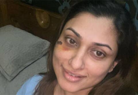 சைக்கிளிங் சென்ற போது விபத்து: அஜித் பட நாயகிக்கு கை விரல் முறிவு