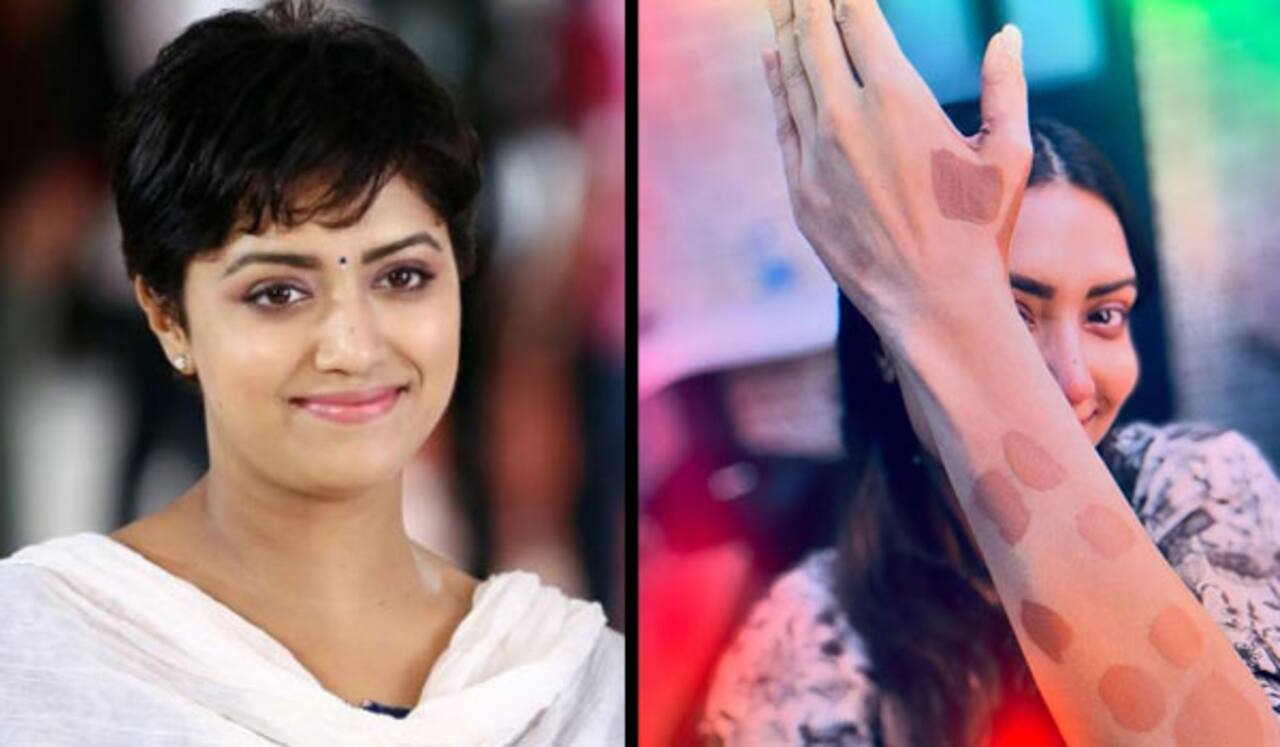 மம்தா மோகன்தாஸிற்கு சரும நோய் பாதிப்பு