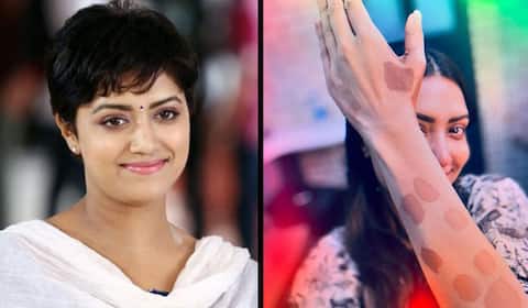 மம்தா மோகன்தாஸிற்கு சரும நோய் பாதிப்பு