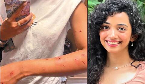 படப்பிடிப்பில் விபத்து: கொதிக்கும் எண்ணெய் கொட்டி சான்வி காயம்