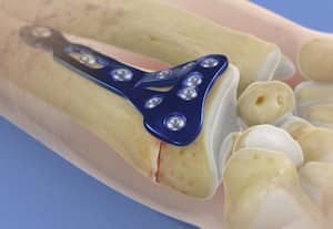 ﻿ எலும்பு முறிவுக்கு பொருத்தும் 'பிளேட்' நவீன வடிவமைப்புக்கு உதவும் 'டிட்கோ'