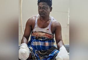  அனுமதியின்றி வெடி தயாரிப்பில் விபத்து;  விரல்களை இழந்த தொழிலாளி