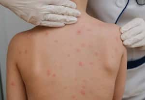    திட்டக்குடி பகுதியில் சின்னம்மை நோய். பரவுகிறது .. சுகாதரத்துறை கண்காணிப்பு தேவை