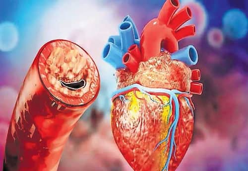 இதய ரத்தக்குழாய்க்கு அறுவை சிகிச்சை தான் தீர்வா?