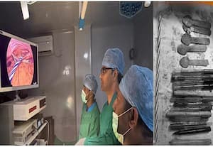 பெண்ணின் வயிற்றில் இருந்து 14 பேனாக்கள், 5 கரண்டிகள், ஒரு மெழுகுவர்த்தி அகற்றிய டாக்டர்கள்!