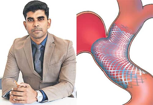 ﻿மூளையிலும் வைக்கலாம் ஸ்டென்ட!