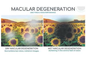 கோடுகள் அலை அலையாய் தெரிகிறதா மறக்காம கண் பரிசோதனை செய்யுங்க