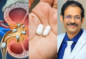சிறுநீரகத்தில் மீண்டும் கல் உருவாவதை தடுக்கலாம்
